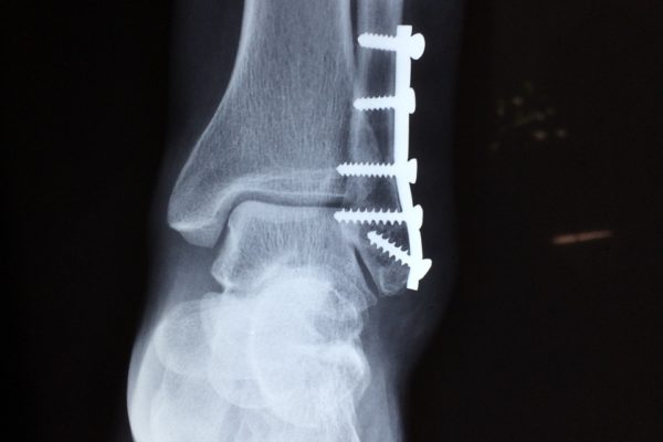 The Different Types of Broken Bones