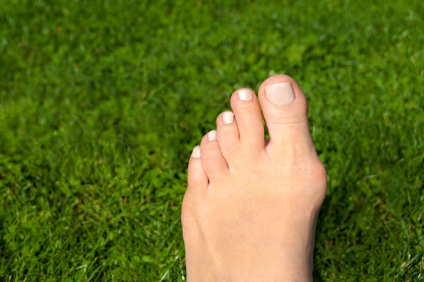 What is a Bunion?