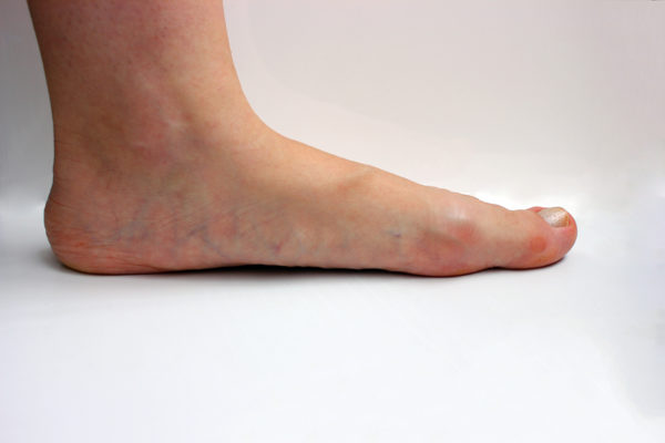 Breaking Down Flatfoot Mechanics