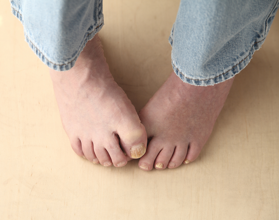 Unsightly Toenails and Fungal Infection