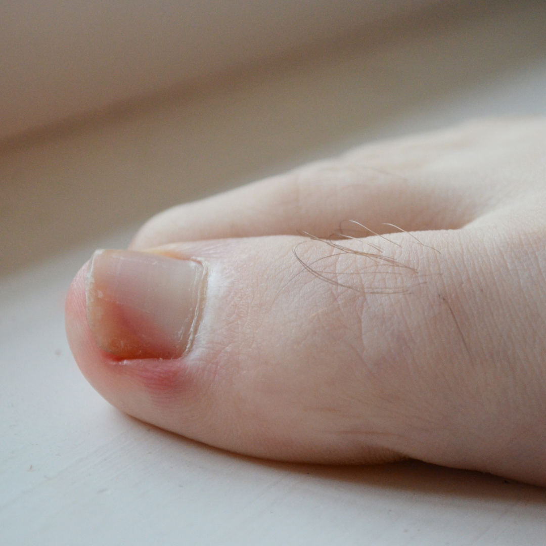 Myths about Ingrown Toenails | Central Ohio Podiatrist | Foot & Ankle Care